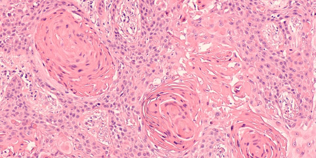 Lung Cancer