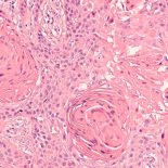 Lung Cancer
